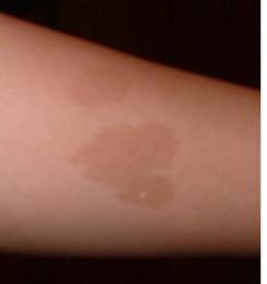 Birthmarks Slideshow: Pictures of Port Wine Stains, Moles ...